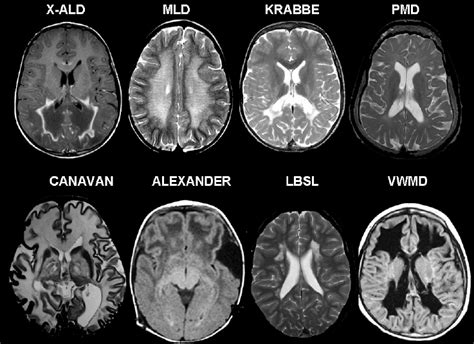 Lesion Patterns on Conventional MRI in Leukodystrophies and... | Download Scientific Diagram