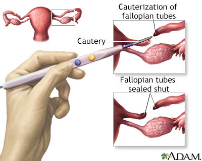 Tubal ligation Information | Mount Sinai - New York