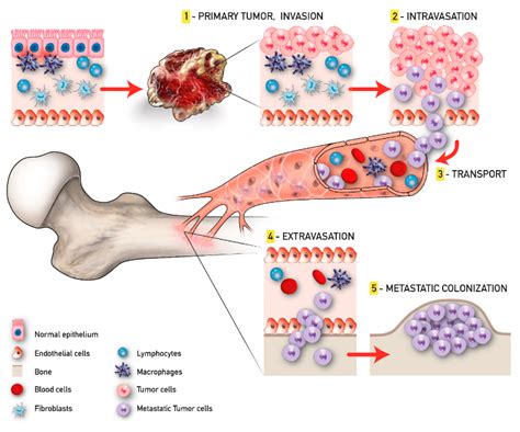 Metastasis