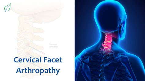 Understanding Cervical Facet Arthropathy: Causes, Symptoms, and Treatments | Best Back Pain ...