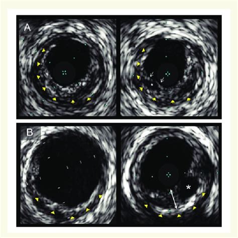 Intravascular ultrasound images of plaques with multiple layers ...