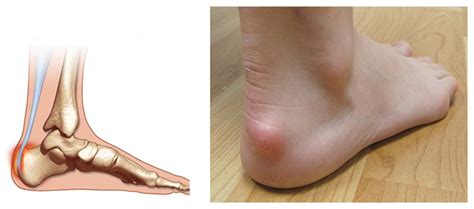 Achilles Bursitis Retrocalcaneal Bursitis Symptoms, Causes Treatment ...