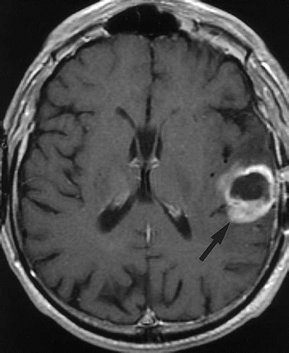 What Are Symptoms Of Brain Tumor In A Cat / Brain Tumors Feline Vsso - Symptoms of a brain tumor ...