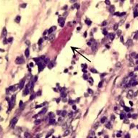 Rhabdomyosarcoma - Symptoms, Types, Causes & Diagnosis