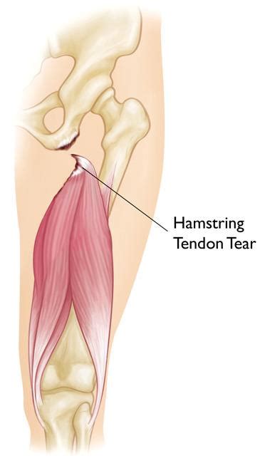 Hamstring Injury Treatment - Hamstring Strain What Is It What Can I Do ...