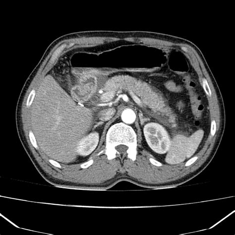 Acute Pancreatitis CT Scan