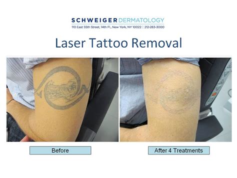 Tattoo Laser Removal