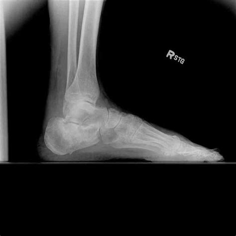 [Figure, Ankle Radiograph, Lateral Calcaneus Fracture Contributed by Scott Dulebohn, MD ...