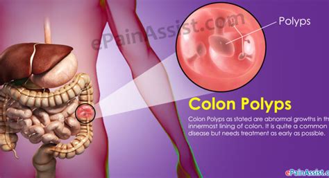 Colon Polyps: Diagnosis and Treatment