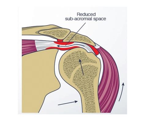 Shoulder Impingement Anatomy