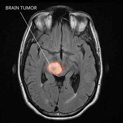 Blood Test May Detect Genetic Changes in Brain Tumors - National Cancer ...