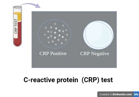 C-reactive protein (CRP) Test: Principle, Procedure, Result • Microbe Online