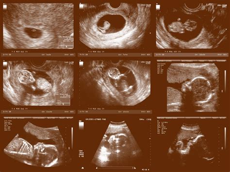 Pregnancy Ultrasounds Week by Week