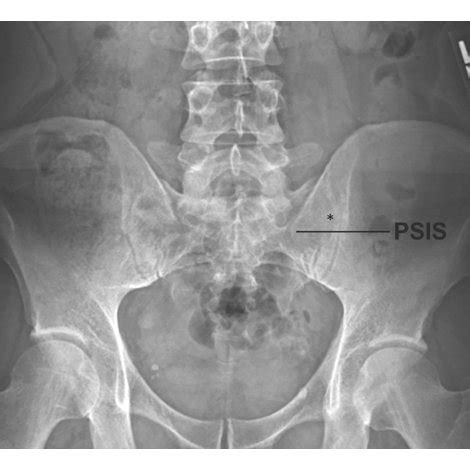 (PDF) Far-Contralateral Oblique (FCO) Sacroiliac Joint Injection ...