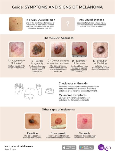 Melanoma Symptoms and Signs: Extensive Guide