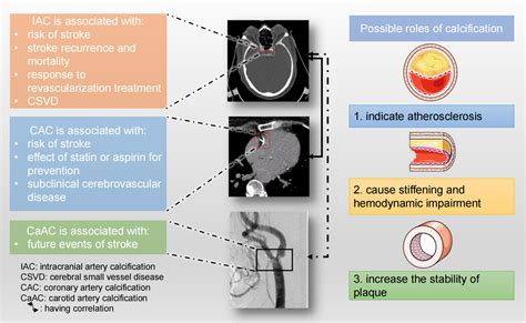 Frontiers | Arterial Calcification and Its Association With Stroke: Implication of Risk ...