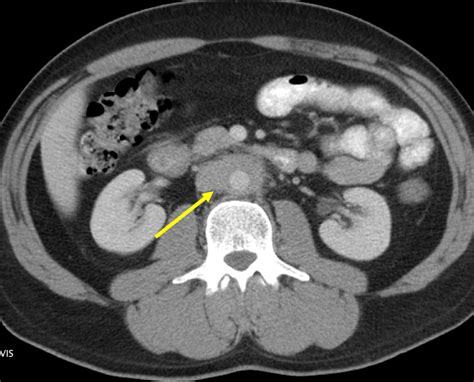 Retroperitoneal Fibrosis