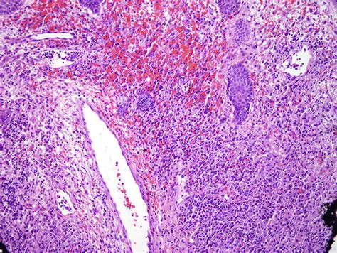 Granuloma Faciale | Dermatopathology