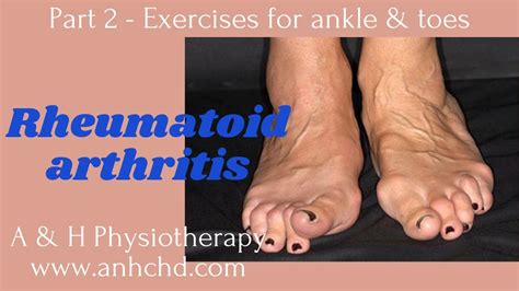 Rheumatoid Arthritis part 2 - Exercises for ankle & toes, Best ...