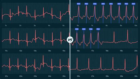 Sinus Rhythm Vs. Ventricular Tachycardia (Non-Sustained) on Your Watch ...