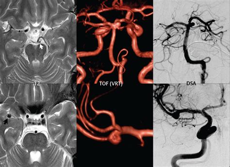 5 Aneurysms | Radiology Key