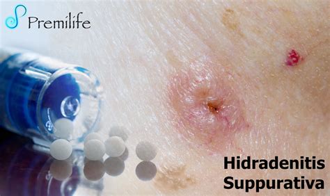 Hidradenitis Suppurativa | Premilife - Homeopathic Remedies