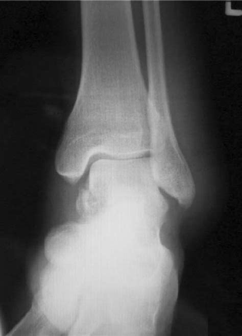 Anteroposterior x-ray image showing ankle joint with inhomogeneous... | Download Scientific Diagram