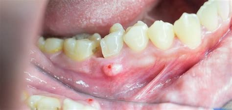 Parulis Fistula: Dental Abscess Treatment and Symptoms | Maiden Lane