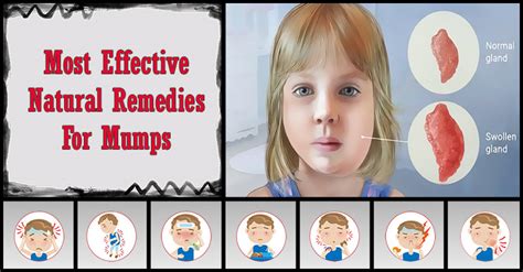 Most Effective Home Remedies For Mumps | Dr Farrah MD