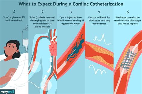 Cardiac Catheterization: Uses, Procedure, Results