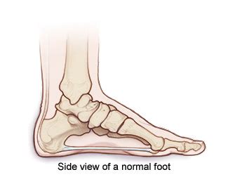 Charcot Foot; Symptoms, Causes, Diagnosis, Treatment & Management