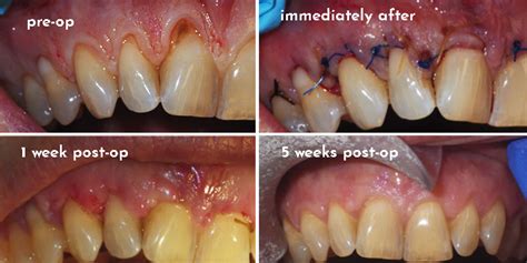 Periodontal Plastic Surgery/Soft Tissue Grafting - Elite Dental ...