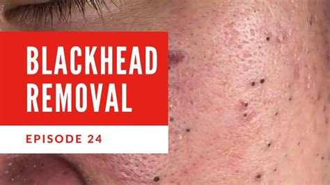 Blackhead Removal Facial and excellent blackhead extraction EP24 - YouTube