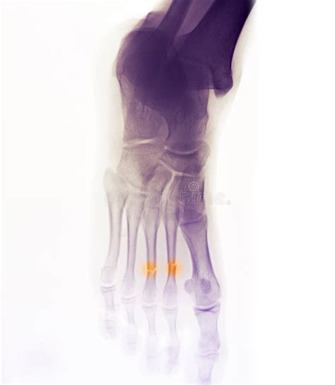 Foot X-ray Showing Fracture Stock Photo - Image of injury, cracked ...