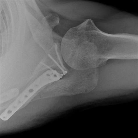 Upper limb Fractures | Dr Sunil Reddy