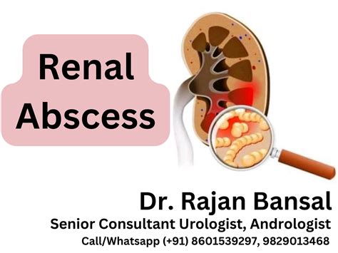 Natural Ways to Prevent Kidney Stones - Dr. Rajan Bansal, Urologist in ...