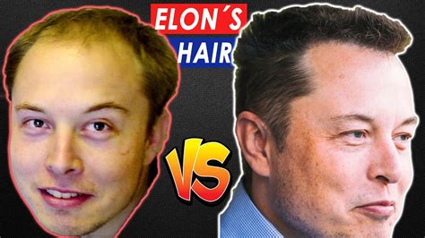 How Elon Musk Got His Hair BACK! - YouTube