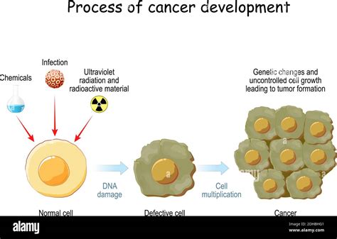 Malignant neoplasm hi-res stock photography and images - Alamy