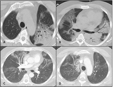 The Role of Bronchoalveolar Lavage in the Diagnosis of COVID-19 Pneumonia: A Report of Three ...