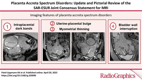 Placenta Accreta Spectrum Disorders: Update and Pictorial Review of the SAR-ESUR Joint Consensus ...