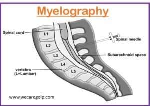 Myelography (Myelogram) - We Care