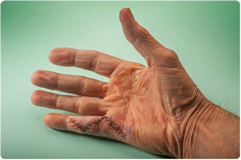 Dupuytren’s Contracture: Causes and Symptoms