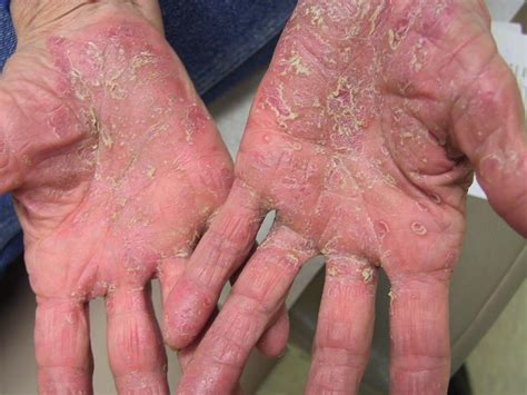 What Causes Psoriasis on Hands | Dorothee Padraig South West Skin ...