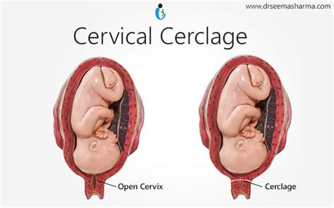 Cervical Cerclage (Cervical Stitch Operation) Procedure | Methods & Risks | Lybrate