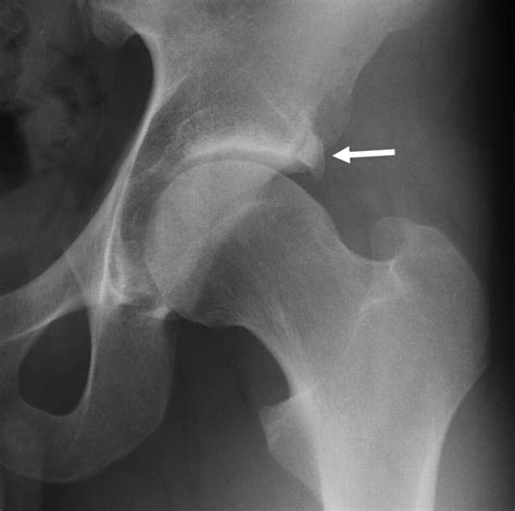 Imaging Of Femoral Acetabular Impingement Syndrome Stress Fractures ...