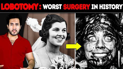 Why is LOBOTOMY The WORST Surgery in History - YouTube