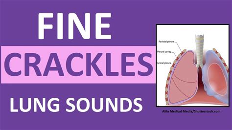 Crackles (Fine) Lung Sounds | Crackles and Rales Breath Sounds Abnormal ...