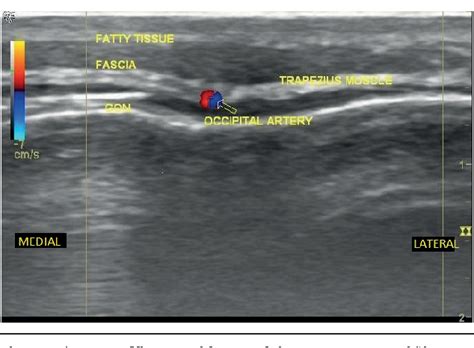 Figure 1 from Ultrasound-Guided Greater Occipital Nerve Blocks and Pulsed Radiofrequency ...