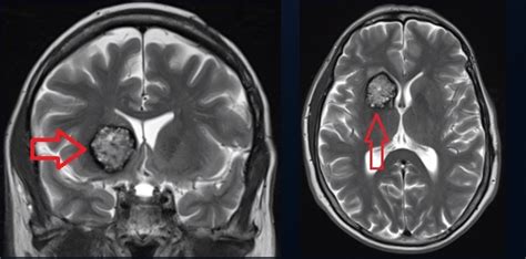 Cavernous Malformation | Barrow Neurological Institute