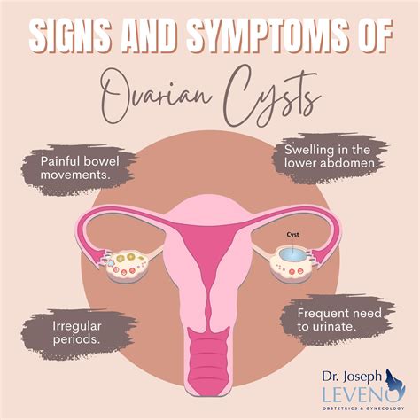 Signs and Symptoms of Ovarian Cysts - Dr. Joseph Leveno